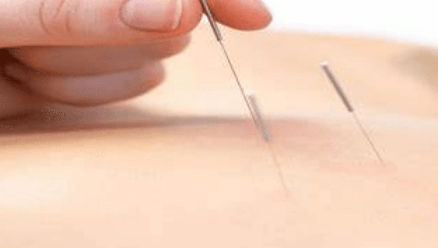 Image for Acupuncture